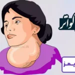 تحقیق در مورد بیماری گواتر