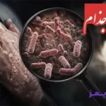 تحقیق درباره بیماری جذام