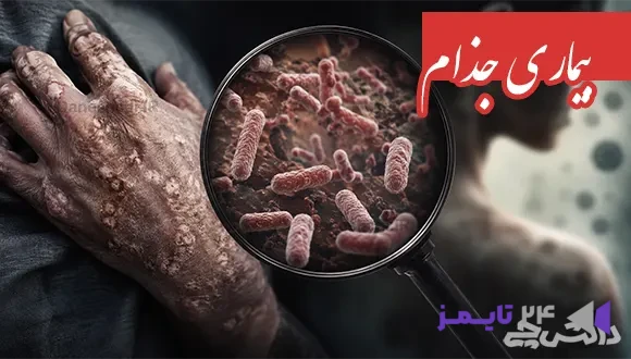 تحقیق درباره بیماری جذام و علایم آن