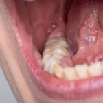 عکس ضایعات زیر زبان