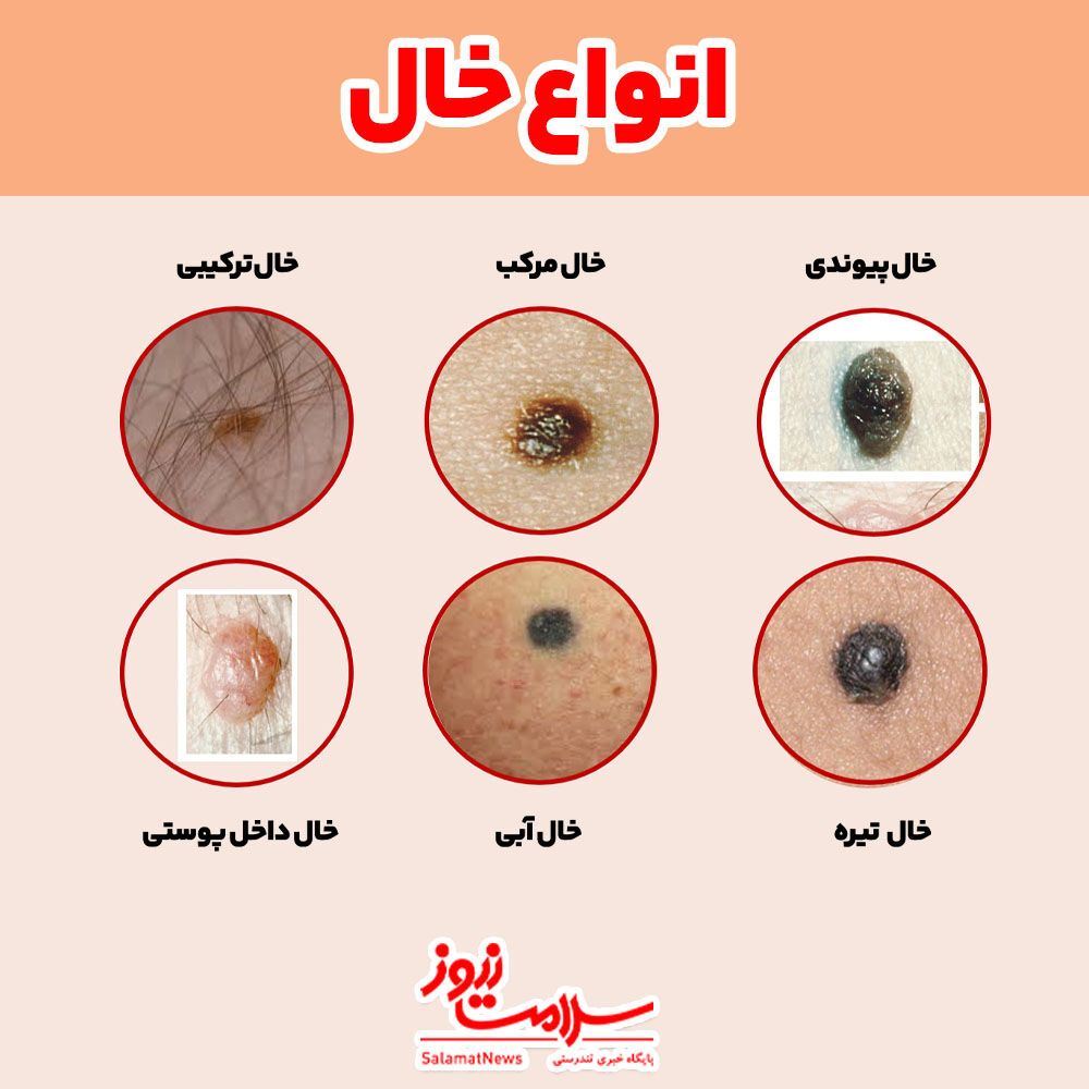 عکس خال های سرطانی