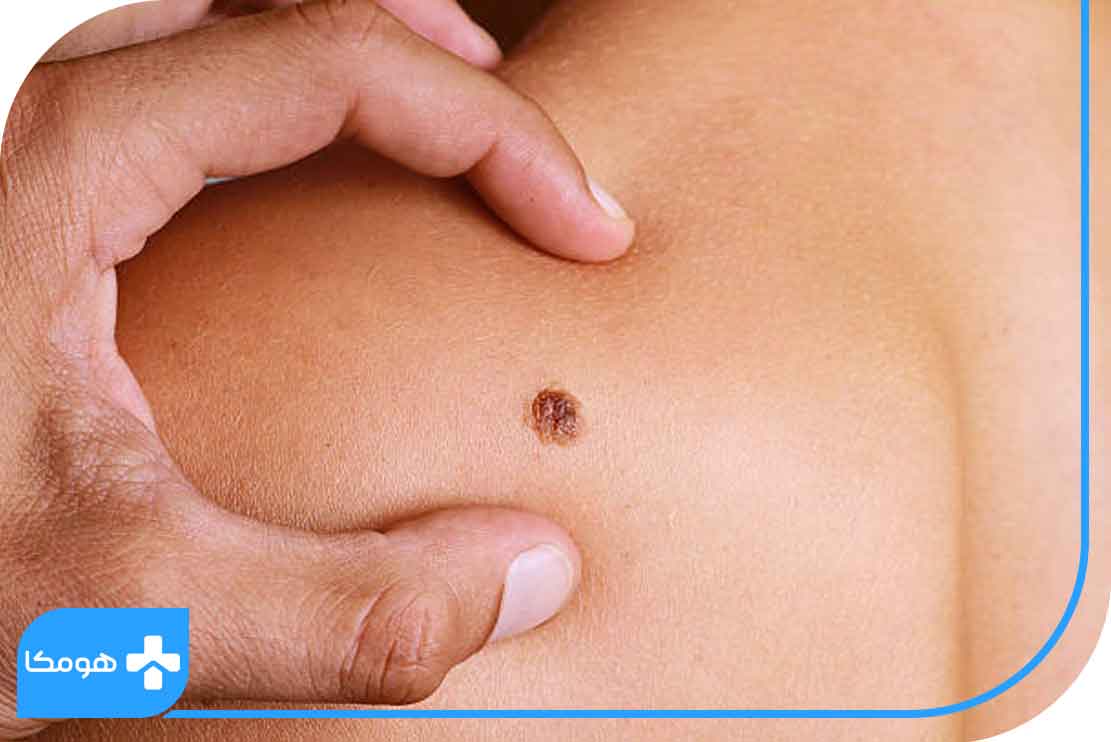 عکس خال های سرطانی