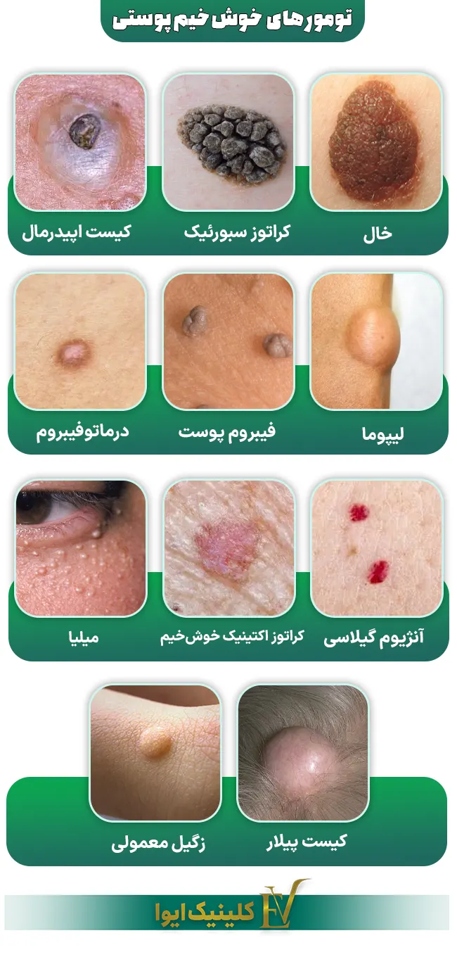عکس خال های سرطانی