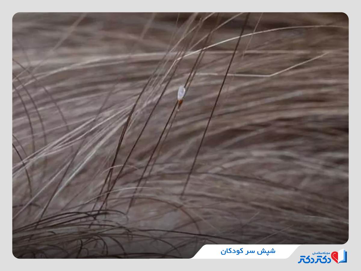 عکس شپش سر