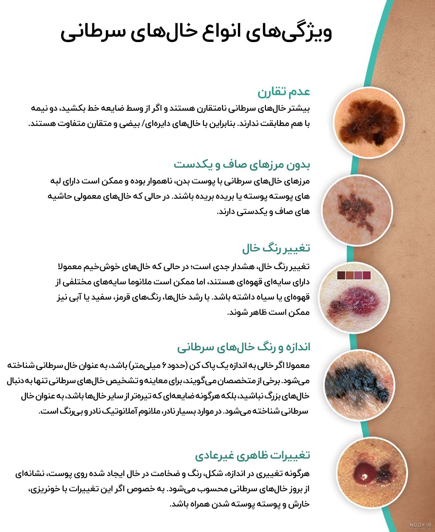 عکس خال های سرطانی